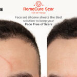 RemeCure-Scar—Face-Set@4x-100